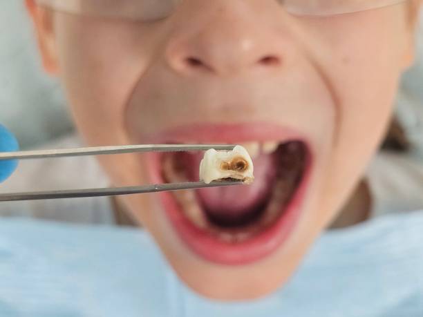 Best Emergency Tooth Extraction in Mechanicsville, MD
